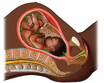 ТОРЧ-инфекции при беременности, когда сдавать, результаты анализа на TORCH-инфекции при беременности