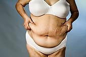 ► Целлюлит – это увеличение жировых клеток и нарушение микроциркуляции в жировой ткани