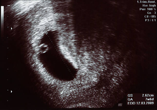 Фото плода на 1 месяце беременности
