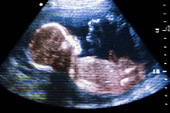 Фото УЗИ на 20 неделе беременности показывает пол ребенка!
