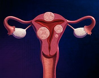 ► Чем опасна миома матки при беременности? Когда хирургическое лечение миомы матки у беременных необходимо?