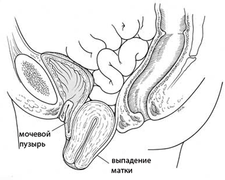 ► Симптомы и лечение опущения матки после родов