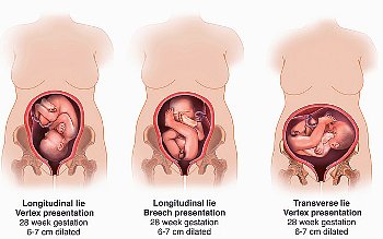 поперечное положение плода, поперечное и косое положение плода, причины, упражнения, неустойчивое поперечное положение плода