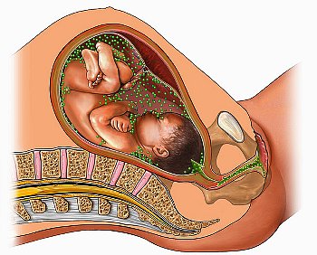 ► Последствия внутриутробной инфекции у новорожденного ребенка