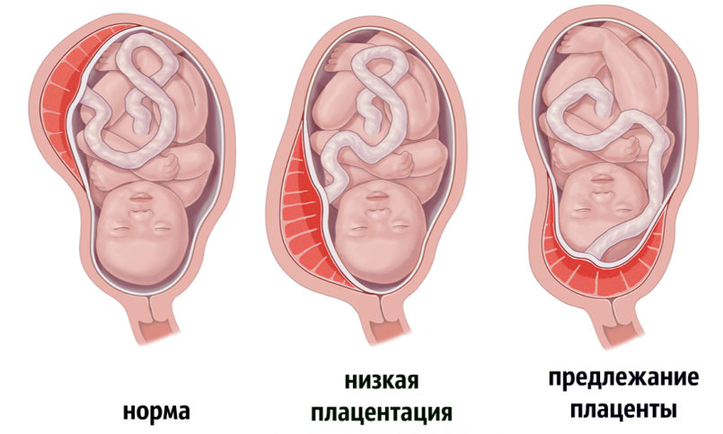 ► Низкая плацентация при беременности — что это значит? Представляем причины, симптомы низкого расположения плаценты, а также методы лечения!