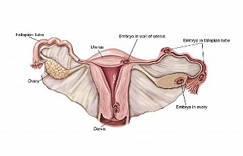 ► Симптомы внематочной беременности на ранних сроках