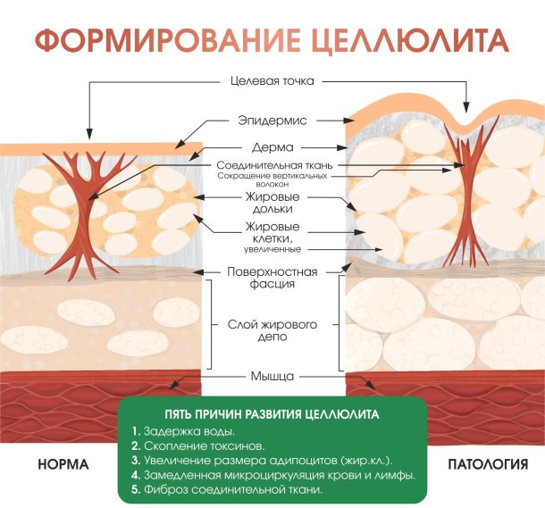 Причины целлюлита Причины возникновения целлюлита
