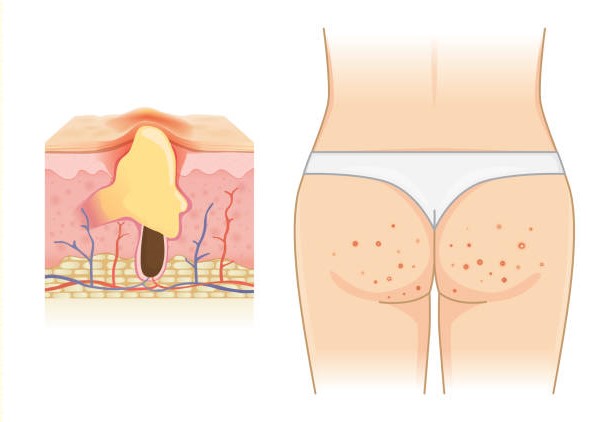 ► 4 способа победить прыщи на ягодицах