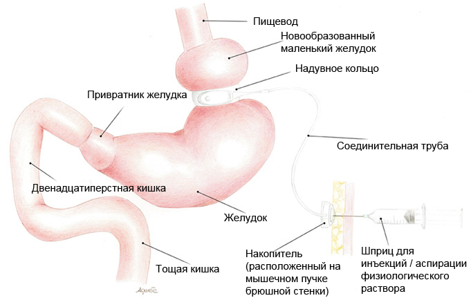 Бандажирование желудка для похудения