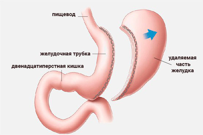 Вертикальная гастропластика желудка для похудения