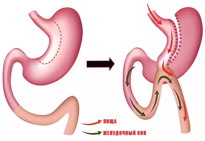 Шунтирование желудка для похудения