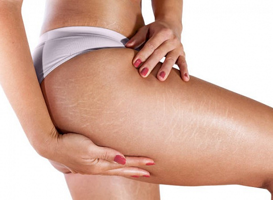 9 способов похудеть в ногах