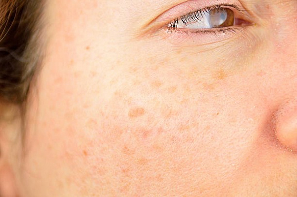 Как из «леопарда» снова превратиться в человека, или о гиперпигментации