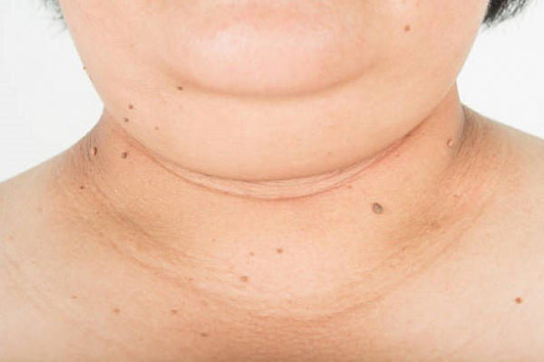 Лучшие способы похудеть в лице