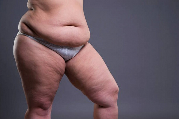 Галифе: как избавиться от липедемы?