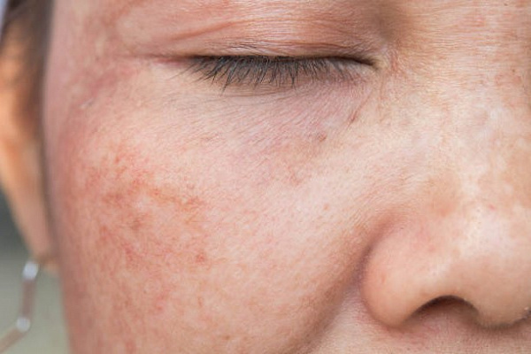 6 методов избавления от старческих пятен