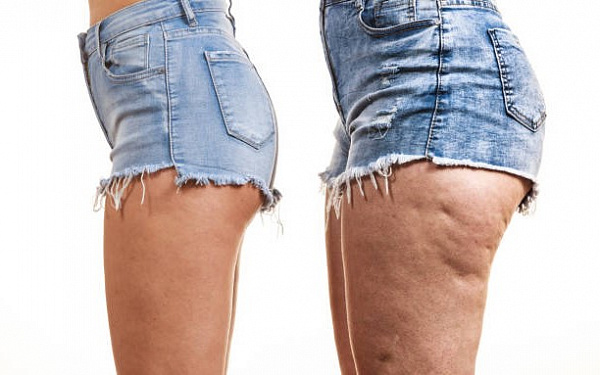 Эти способы помогают убрать целлюлит