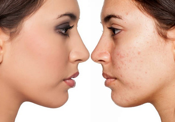 Эти советы помогут убрать акне с твоего лица