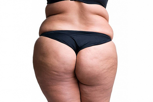 Что могут рассказать о здоровье жировые отложения?