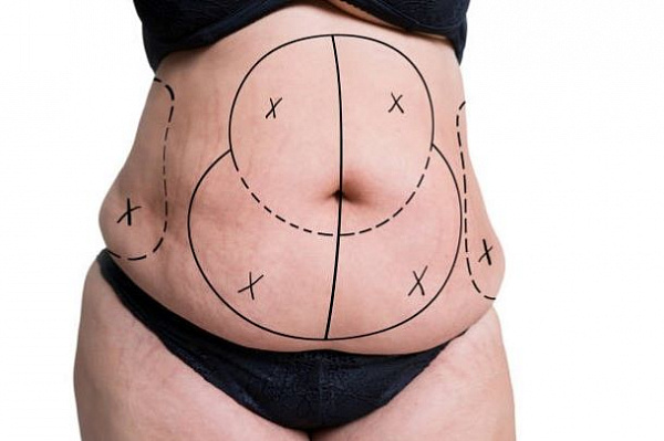 Радикальные методы избавления от жира на животе