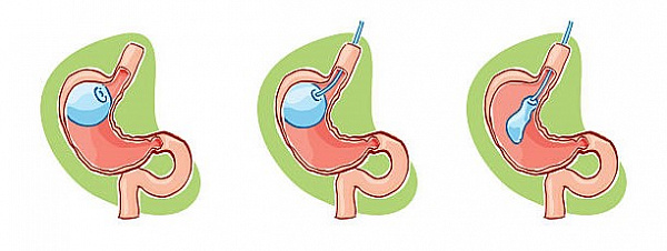 Похудение принудительного типа: как шарики могут помочь сбросить вес
