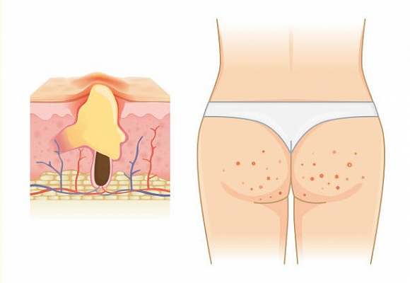4 способа победить прыщи на ягодицах