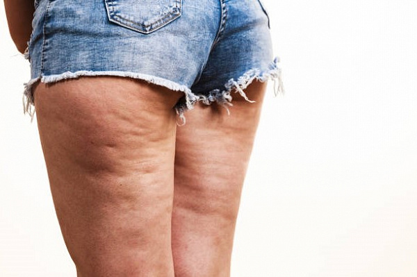 Чем же так опасен целлюлит