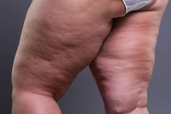 Липедема: когда рост жира не прекращается