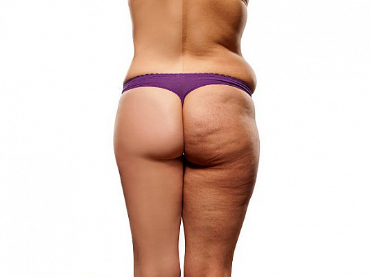 4 самых эффективных способа победить целлюлит