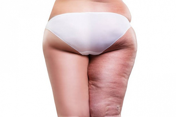 Как укрепить соединительную ткань и избавиться от целлюлита