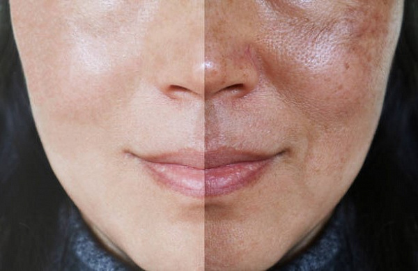 Лучшие способы уменьшить поры