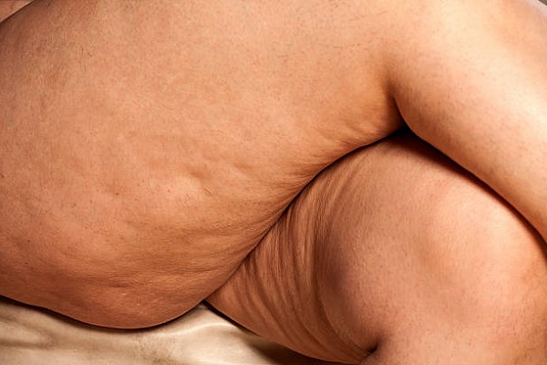 Эти продукты виноваты в появлении целлюлита