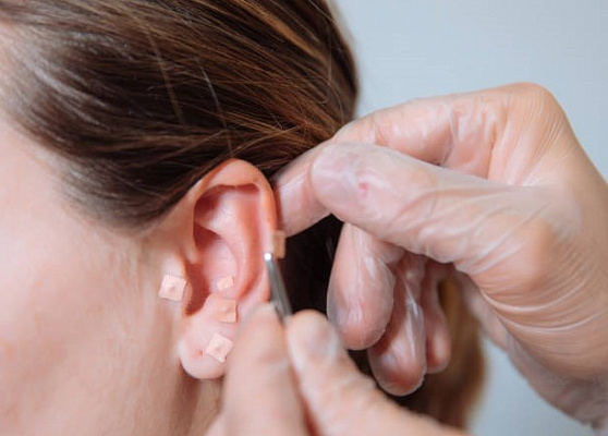 Похудение при помощи иглоукалывания: правда или миф?