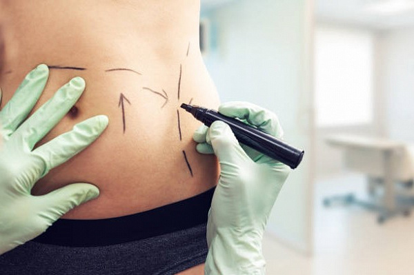 Липосакция – не метод