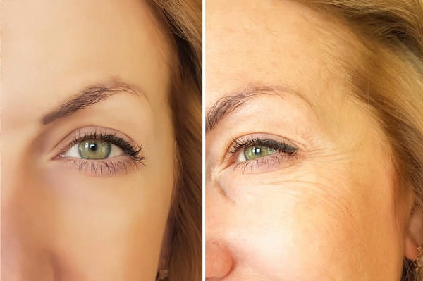 Лучшие способы победить морщины вокруг глаз