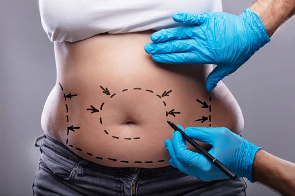 Прощай, жир: похудение на операционном столе
