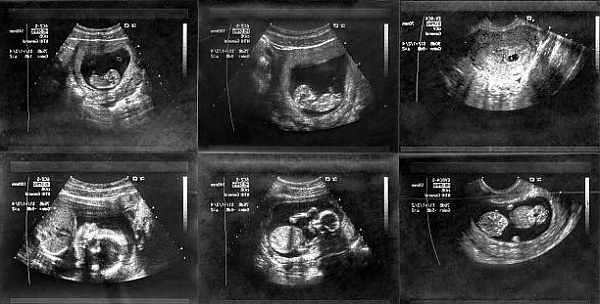 Ученые назвали основные угрозы УЗИ для будущих детей