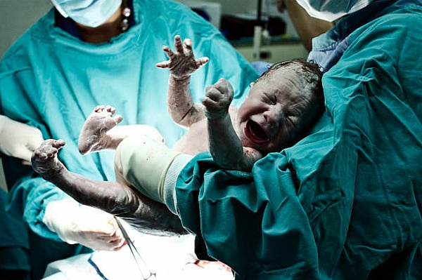 Популярность кесарева