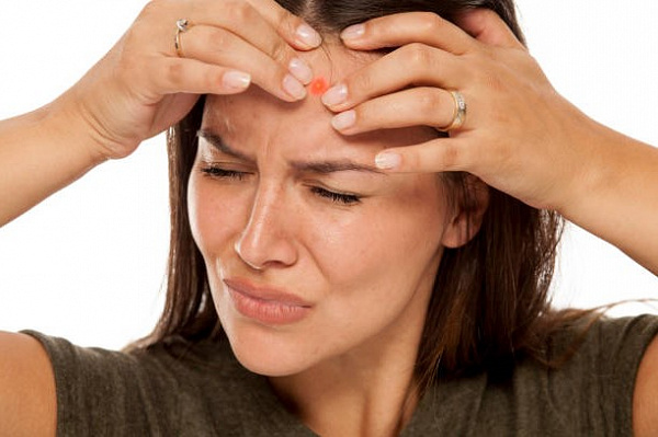 13 главных причин появления прыщей