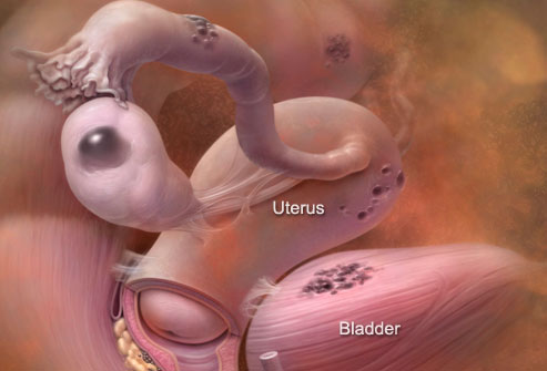 ► Что это такое эндометриоз тела матки
