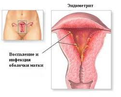 ► Хронический эндометрит и беременность
