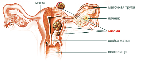 Множественная миома матки больших размеров