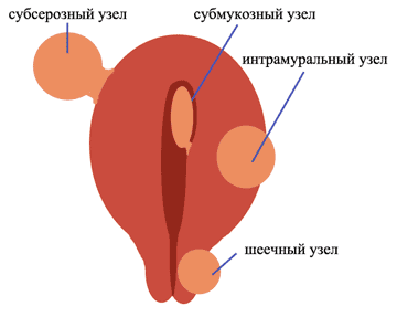 ► Миома матки больших, малых размеров лечение народными средствами