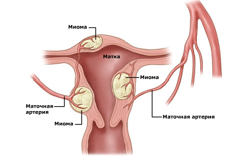 ► Симптомы и признаки миомы матки
